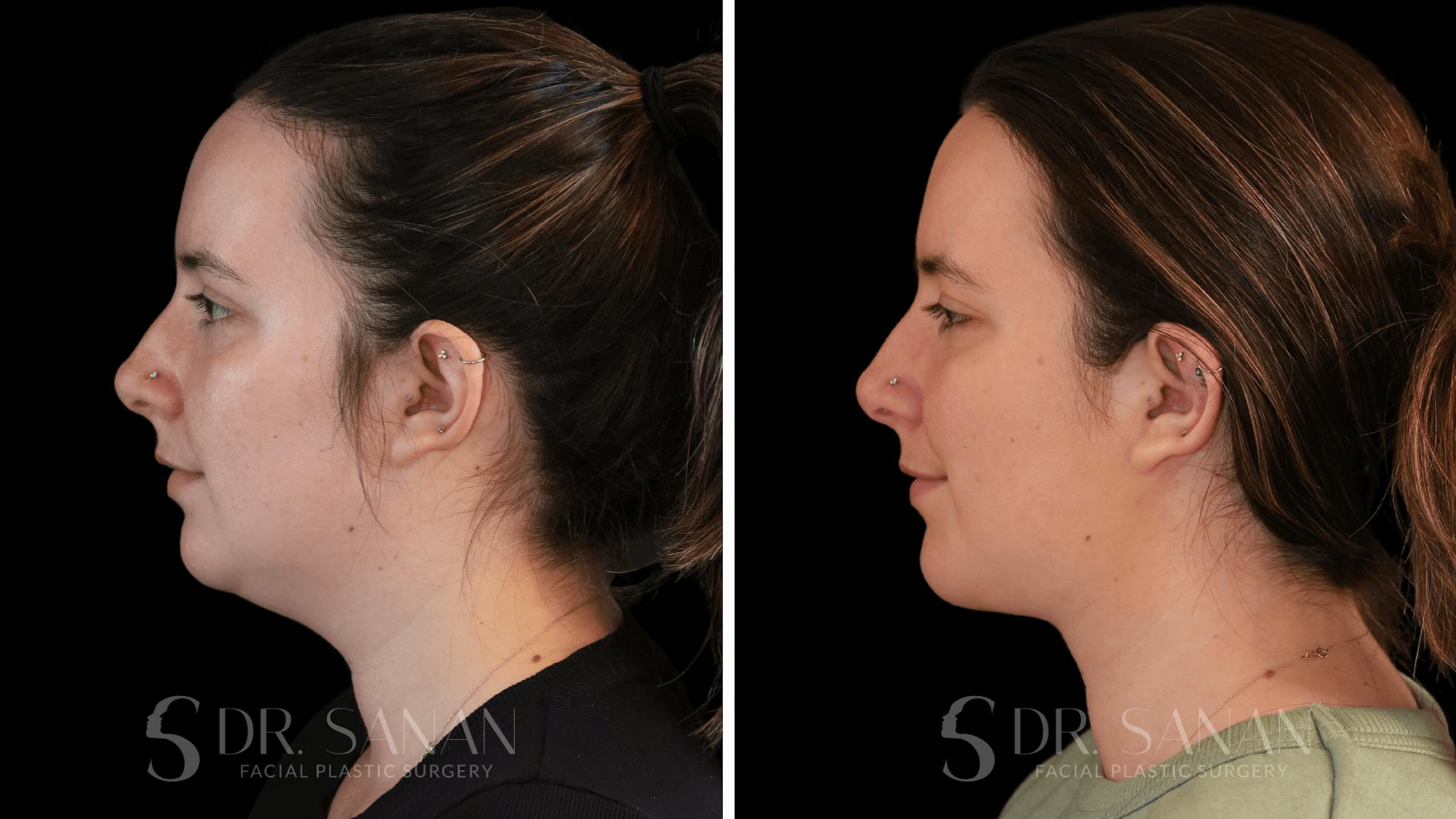 Neck Lift Before & After Gallery - Patient 306343 - Image 1