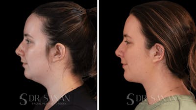 Neck Lift Before & After Gallery - Patient 306343 - Image 1