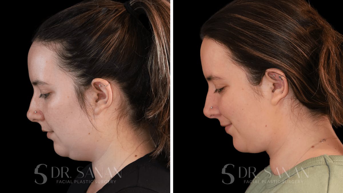 Buccal Fat Reduction Before & After Gallery - Patient 612930 - Image 1