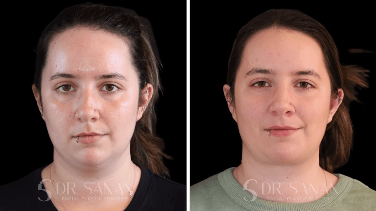 Buccal Fat Reduction Before & After Gallery - Patient 612930 - Image 5