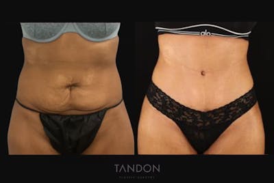 Abdominoplasty (Tummy Tuck) Before & After Gallery - Patient 198125 - Image 1