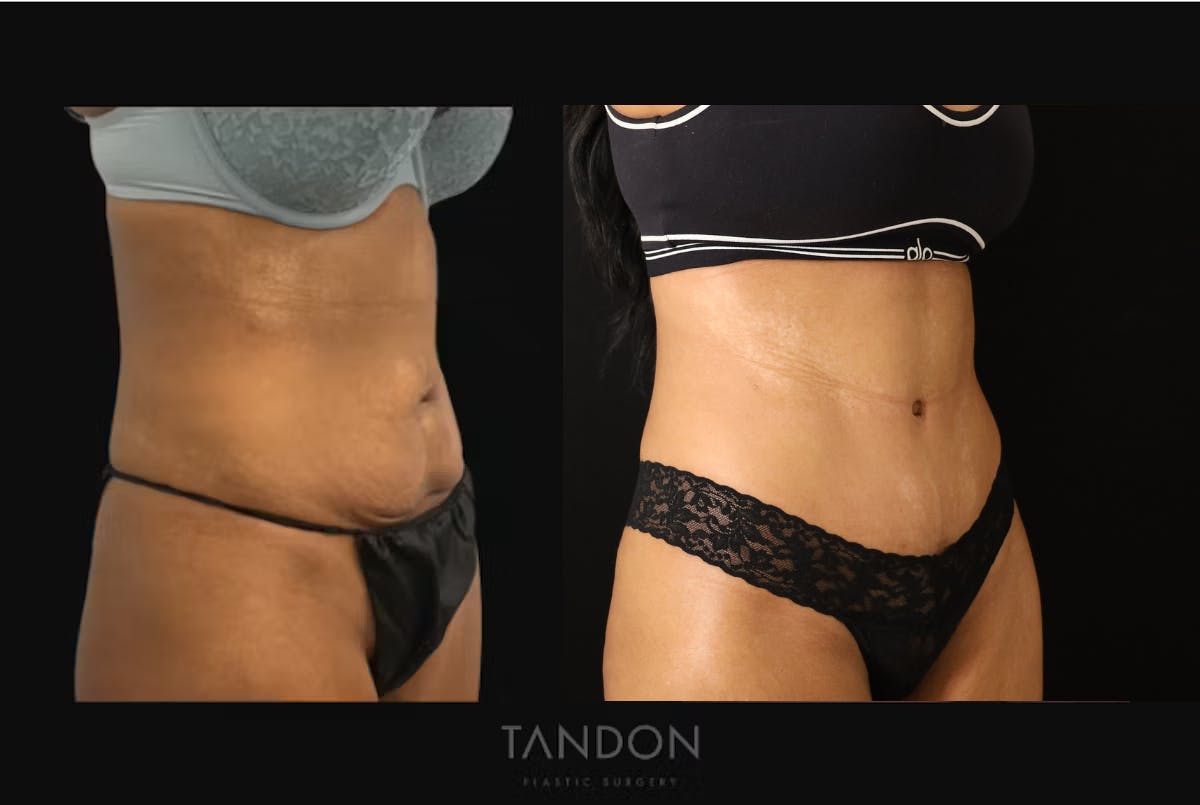Abdominoplasty (Tummy Tuck) Before & After Gallery - Patient 198125 - Image 2