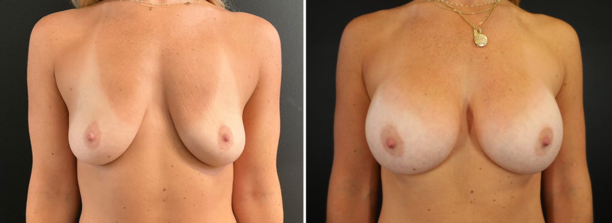 Breast Augmentation Before & After Gallery - Patient 456224 - Image 1