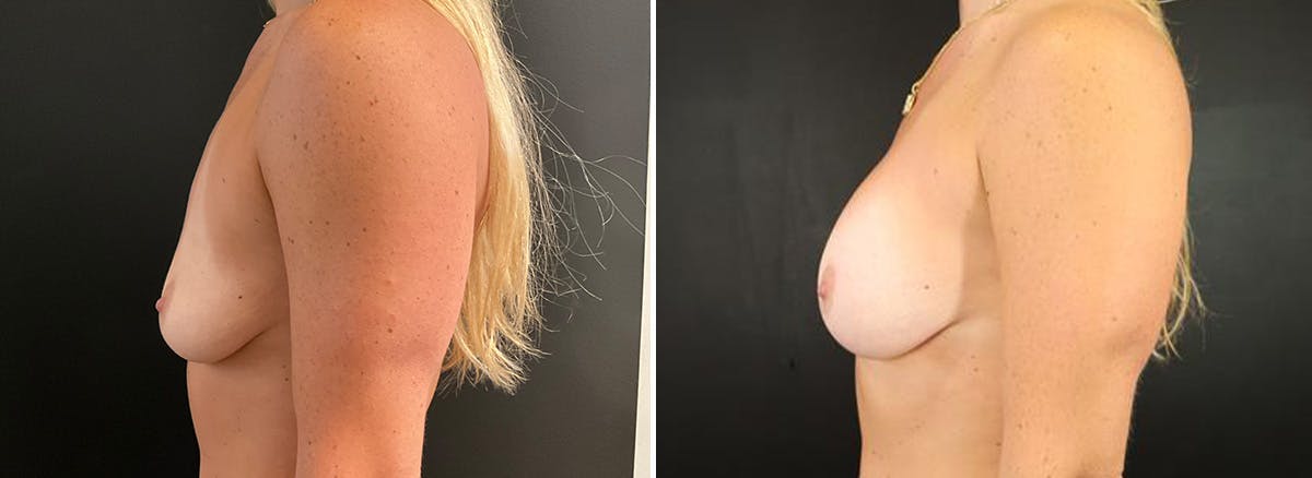 Breast Augmentation Before & After Gallery - Patient 456224 - Image 3