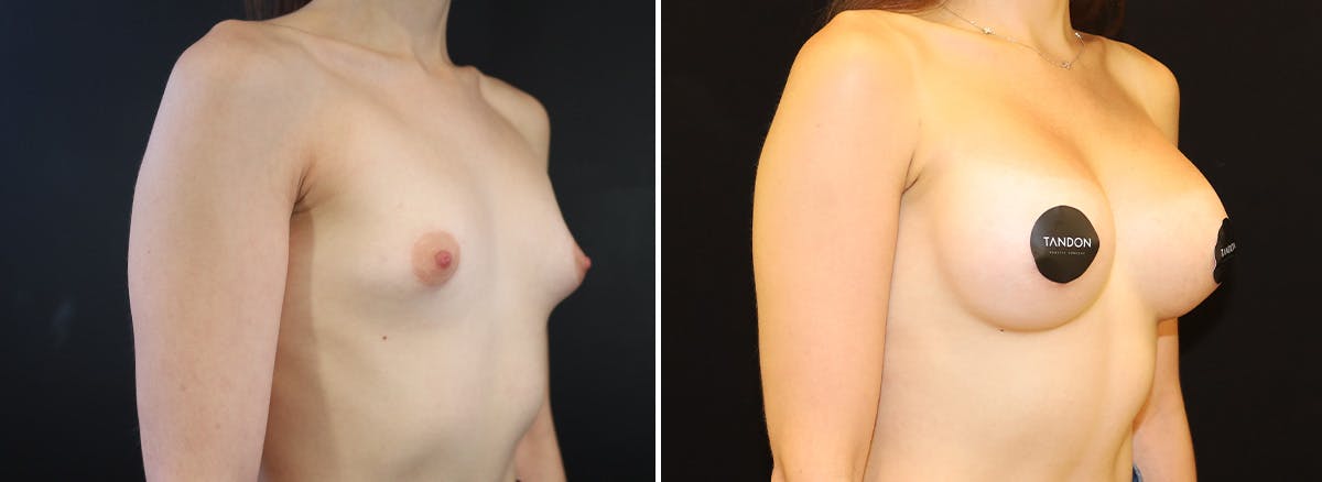 Breast Augmentation Before & After Gallery - Patient 296938 - Image 1