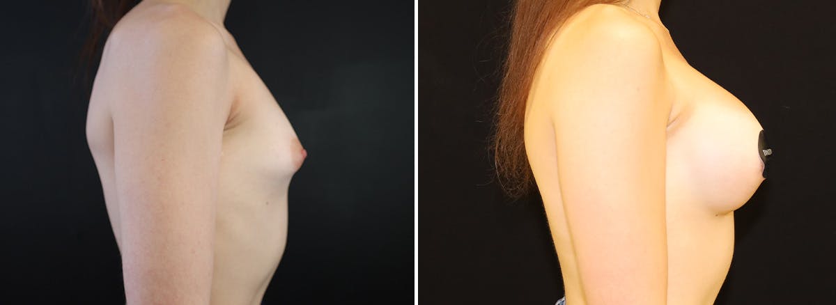 Breast Augmentation Before & After Gallery - Patient 296938 - Image 2