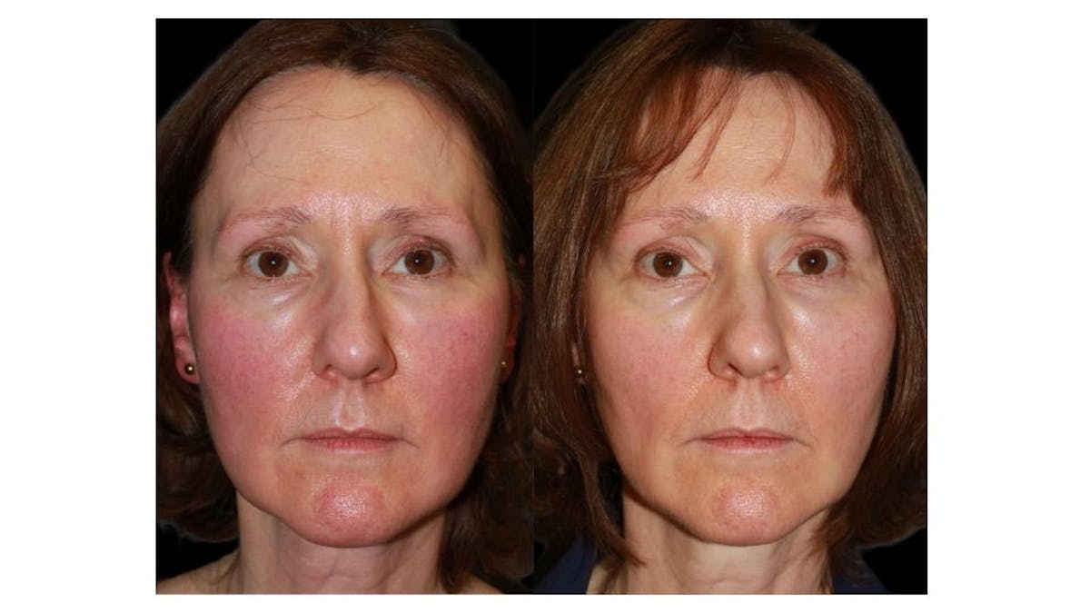 Excel V Before & After Gallery - Patient 108437 - Image 1