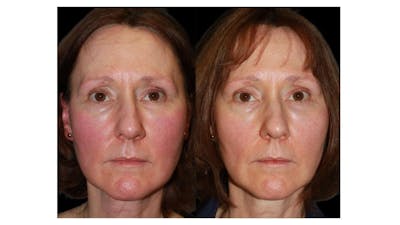 Excel V Before & After Gallery - Patient 108437 - Image 1