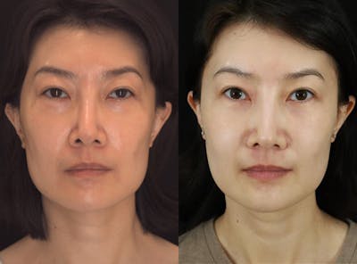 Fat Transfer Before & After Gallery - Patient 363124 - Image 1