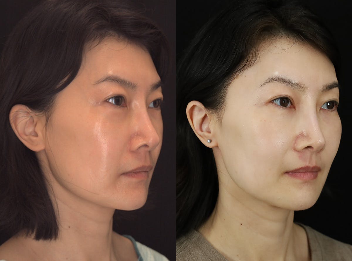 Fat Transfer Before & After Gallery - Patient 363124 - Image 2