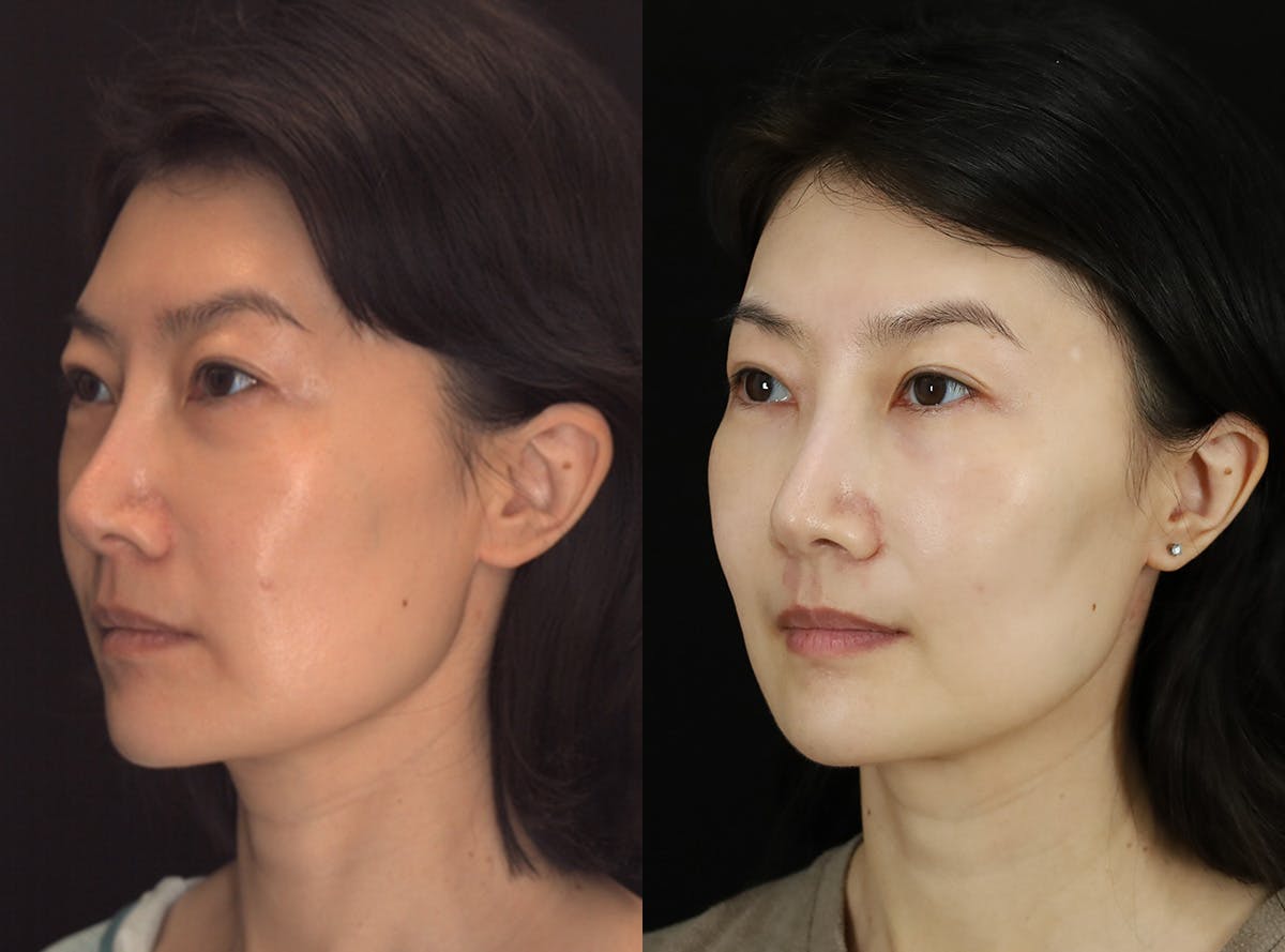 Fat Transfer Before & After Gallery - Patient 363124 - Image 3