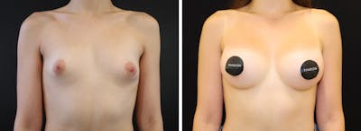 Breast Augmentation Before & After Gallery - Patient 296938 - Image 1