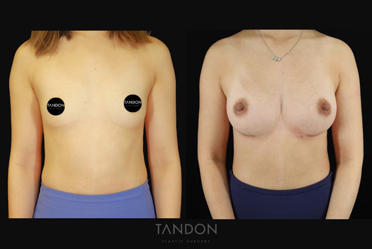 Breast Augmentation Before & After Gallery - Patient 167079 - Image 1