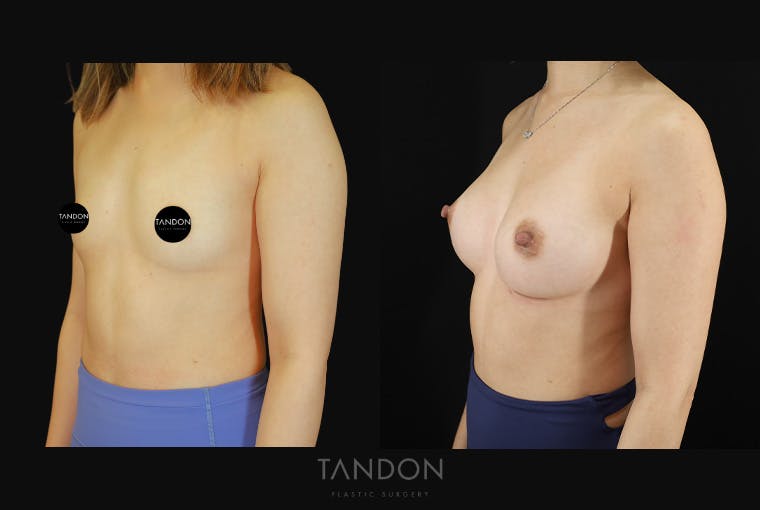 Breast Augmentation Before & After Gallery - Patient 167079 - Image 4