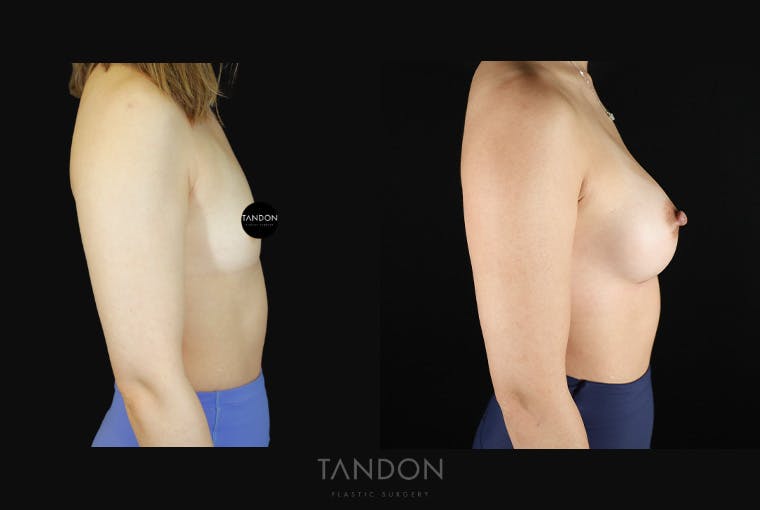 Breast Augmentation Before & After Gallery - Patient 167079 - Image 3