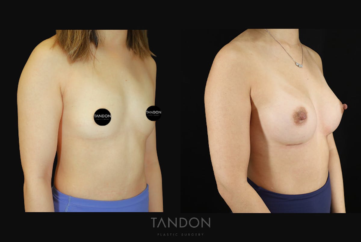 Breast Augmentation Before & After Gallery - Patient 167079 - Image 2