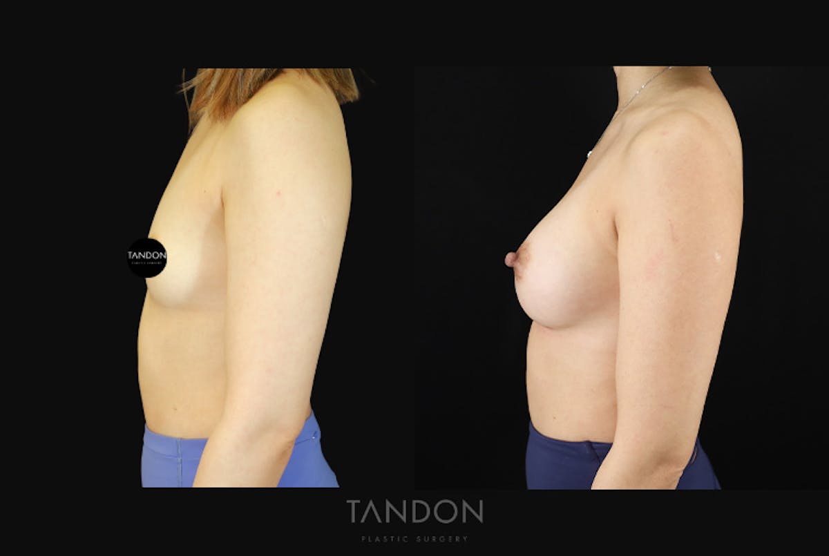 Breast Augmentation Before & After Gallery - Patient 167079 - Image 5
