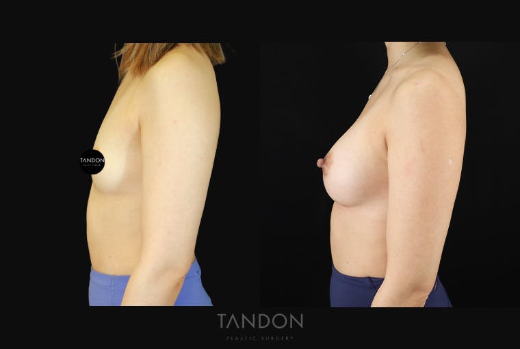 Breast Augmentation Before & After Gallery - Patient 167079 - Image 5
