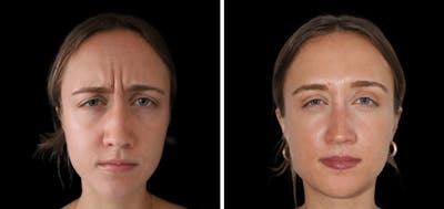 Botox Before & After Gallery - Patient 339565 - Image 1