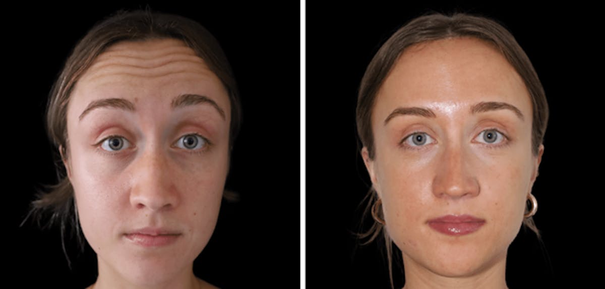Botox Before & After Gallery - Patient 339565 - Image 2