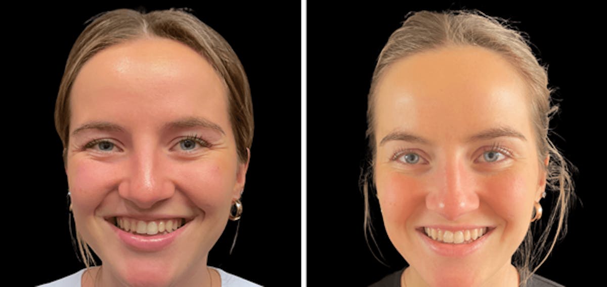 Botox Before & After Gallery - Patient 150201 - Image 3