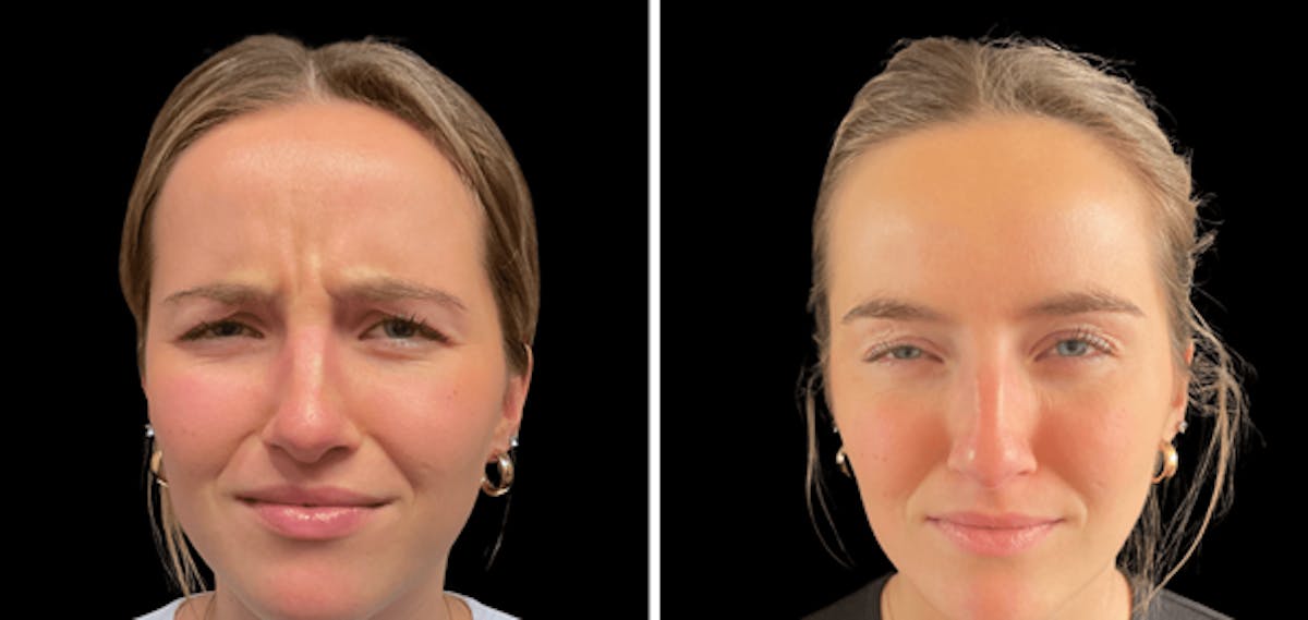Botox Before & After Gallery - Patient 150201 - Image 2