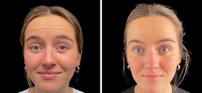 Botox Before & After Gallery - Patient 150201 - Image 1