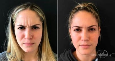Botox Before & After Gallery - Patient 369035 - Image 1