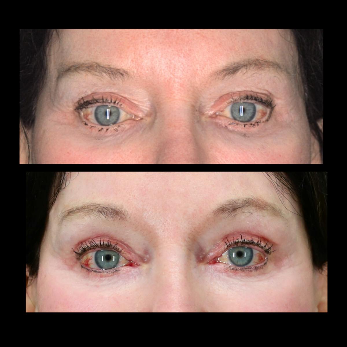 Blepharoplasty Before & After Gallery - Patient 333313 - Image 1