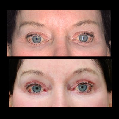 Blepharoplasty Before & After Gallery - Patient 333313 - Image 1