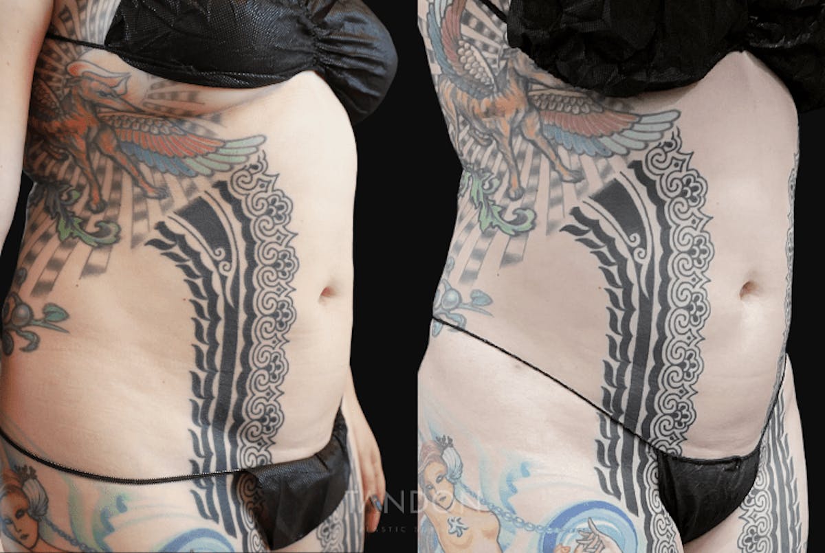 Liposuction Before & After Gallery - Patient 182735 - Image 2