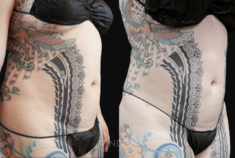 Liposuction Before & After Gallery - Patient 182735 - Image 2