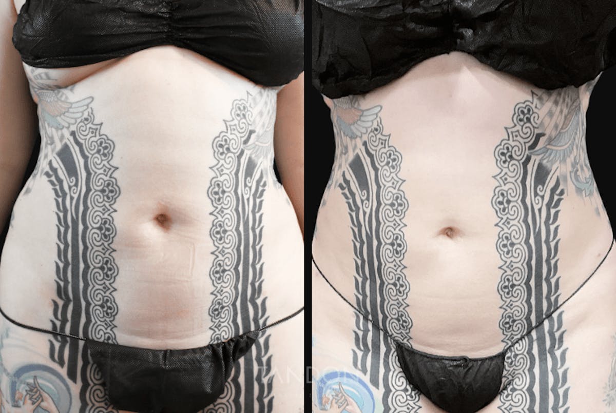 Liposuction Before & After Gallery - Patient 182735 - Image 1