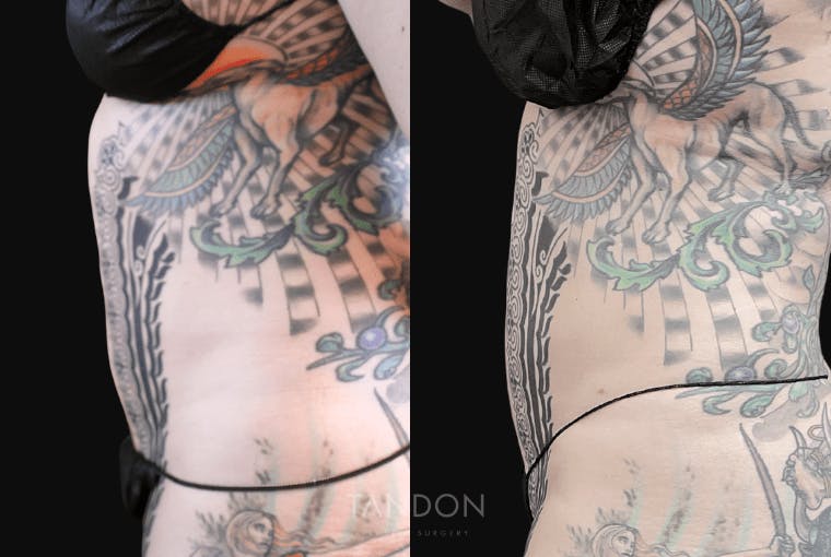 Liposuction Before & After Gallery - Patient 182735 - Image 5