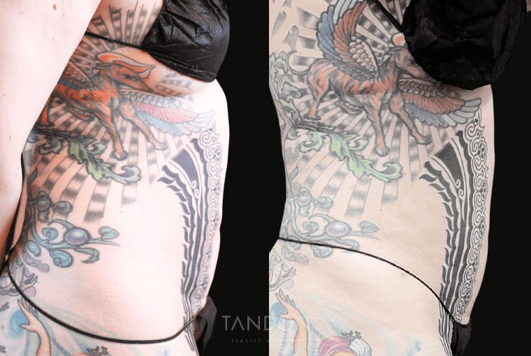 Liposuction Before & After Gallery - Patient 182735 - Image 3