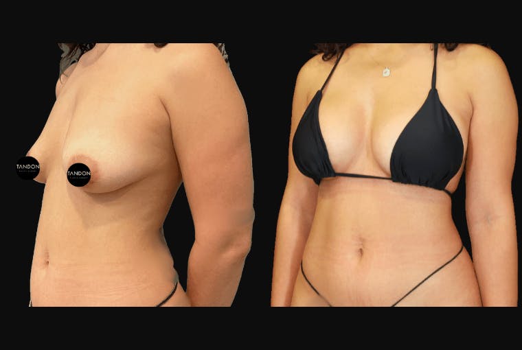 Breast Augmentation Before & After Gallery - Patient 831413 - Image 3