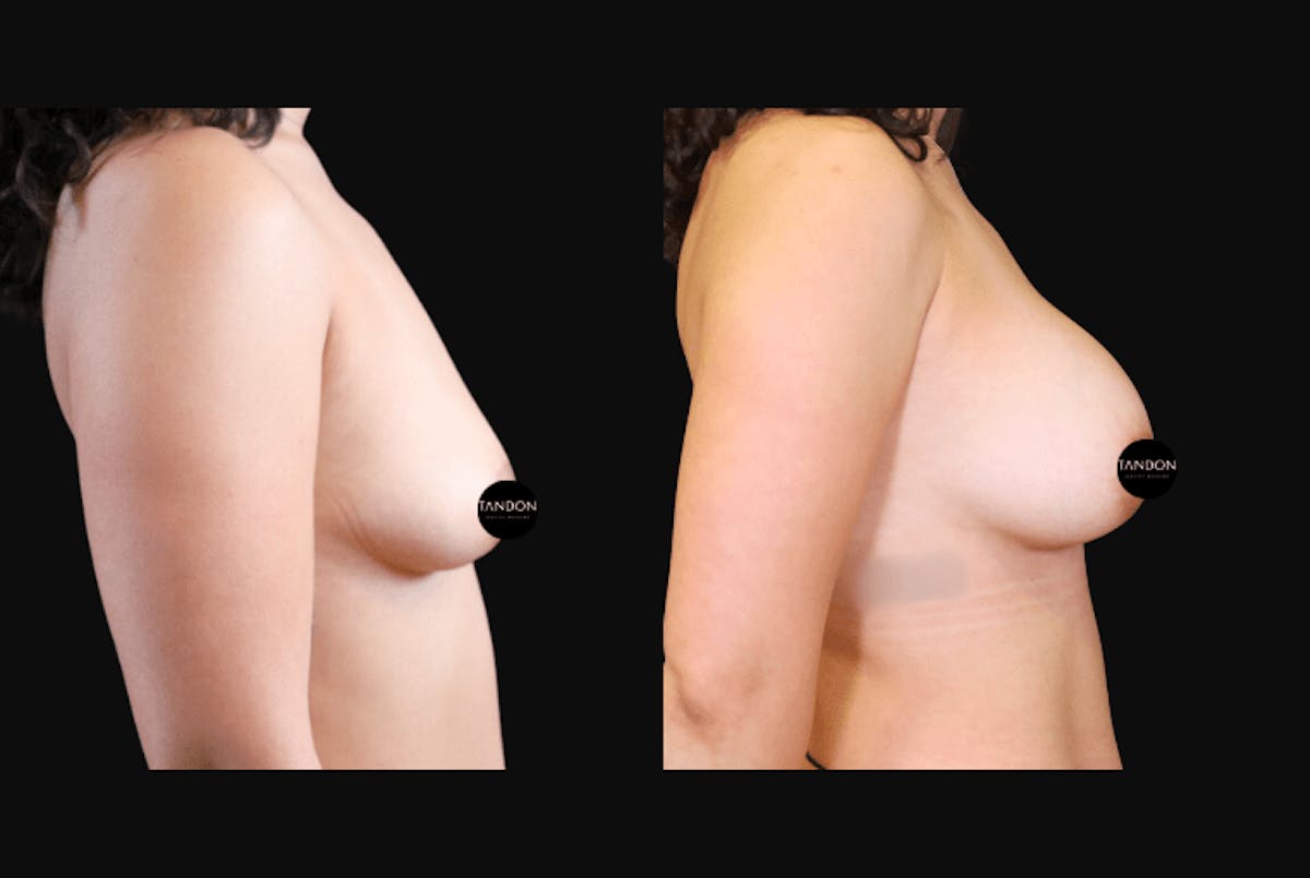 Breast Augmentation Before & After Gallery - Patient 831413 - Image 6