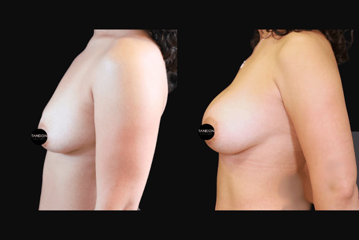 Breast Augmentation Before & After Gallery - Patient 831413 - Image 5