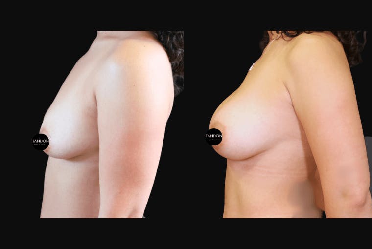Breast Augmentation Before & After Gallery - Patient 831413 - Image 5