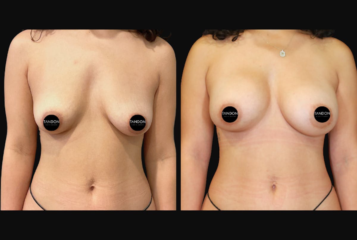 Breast Augmentation Before & After Gallery - Patient 831413 - Image 1