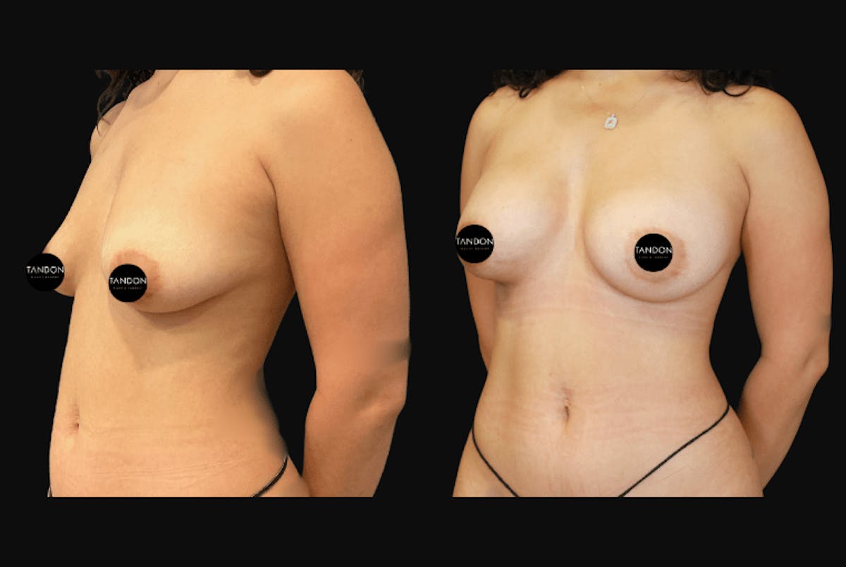 Breast Augmentation Before & After Gallery - Patient 831413 - Image 4
