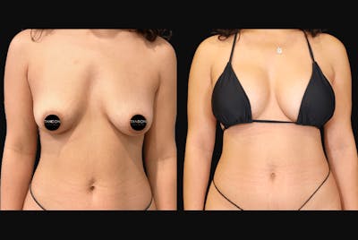 Liposuction and Fat Transfer Before & After Gallery - Patient 402589 - Image 2