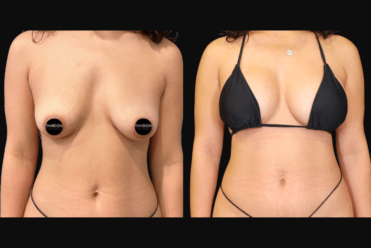 Breast Augmentation Before & After Gallery - Patient 831413 - Image 2
