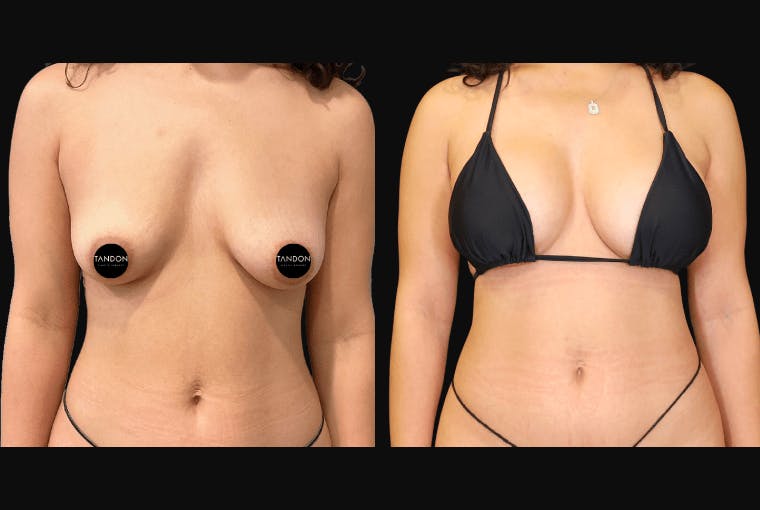 Breast Augmentation Before & After Gallery - Patient 831413 - Image 2