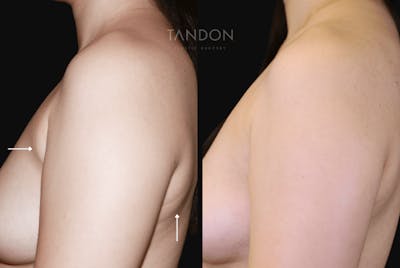 Liposuction and Fat Transfer Before & After Gallery - Patient 105822 - Image 2