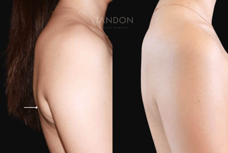 Liposuction Before & After Gallery - Patient 105822 - Image 1