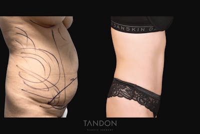 Liposuction and Fat Transfer Before & After Gallery - Patient 428447 - Image 2