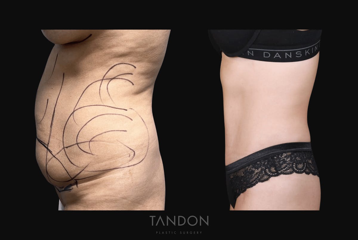 Abdominoplasty (Tummy Tuck) Before & After Gallery - Patient 227220 - Image 4