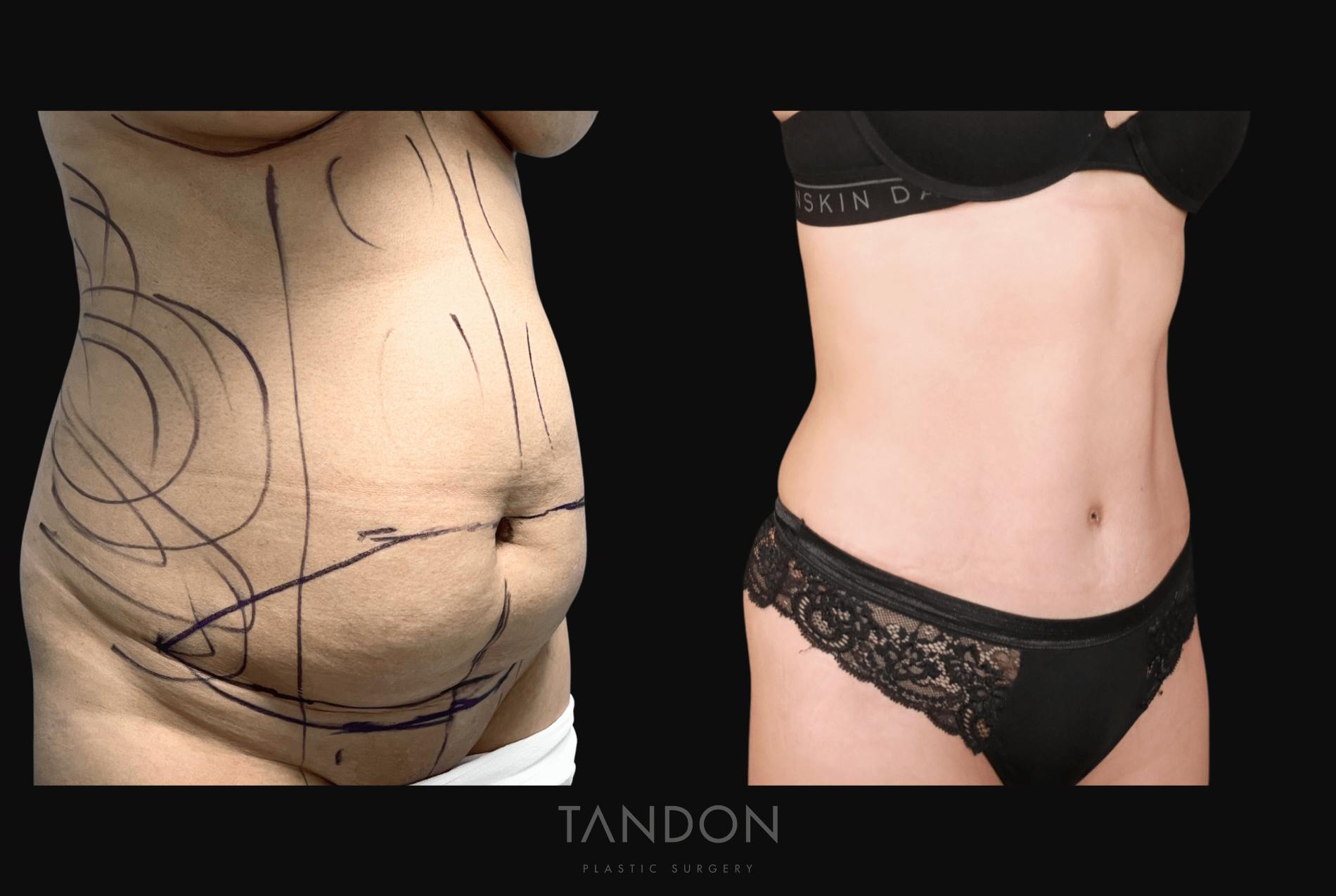 Liposuction Before & After Gallery - Patient 428447 - Image 1