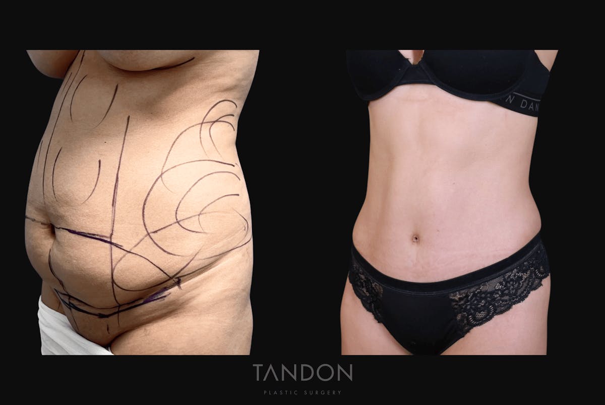 Abdominoplasty (Tummy Tuck) Before & After Gallery - Patient 227220 - Image 3